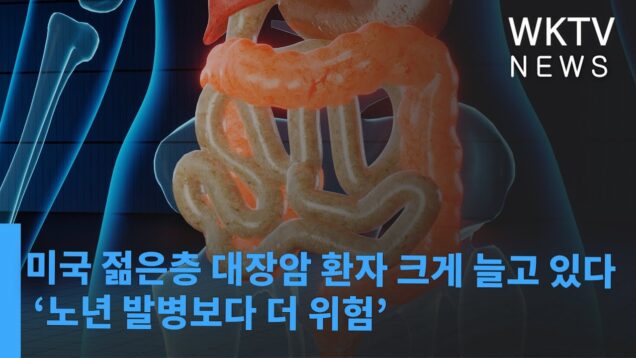 미국 젊은층 대장암 환자 크게 늘고 있다 ‘노년 발병보다 더 위험’