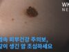 폭염속 피부건강 주의보, 점같이 생긴 암 조심하세요