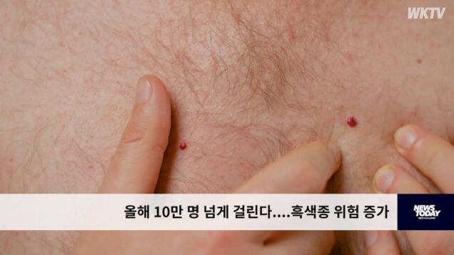 올해 10만 명 넘게 걸린다 ‘흑색종 위험 증가’