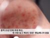 미 홍역 35년 만에 최대 확산, 첫 사망 놓고 케네디 장관·펜실베니아 충돌