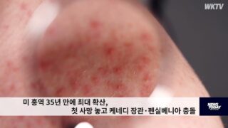 미 홍역 35년 만에 최대 확산, 첫 사망 놓고 케네디 장관·펜실베니아 충돌